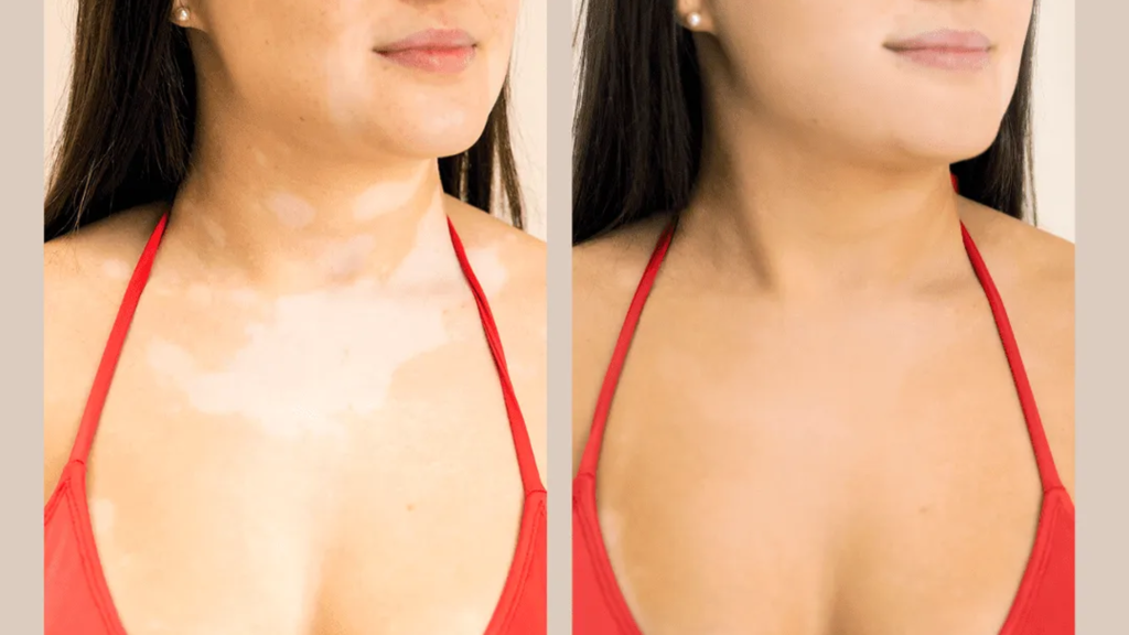 Autobronzeador Sempre Verão: trata Vitiligo e Psoríase em casa e não mancha.