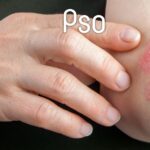 O Impacto Emocional da Psoríase e Como a Autoestima Pode Voltar