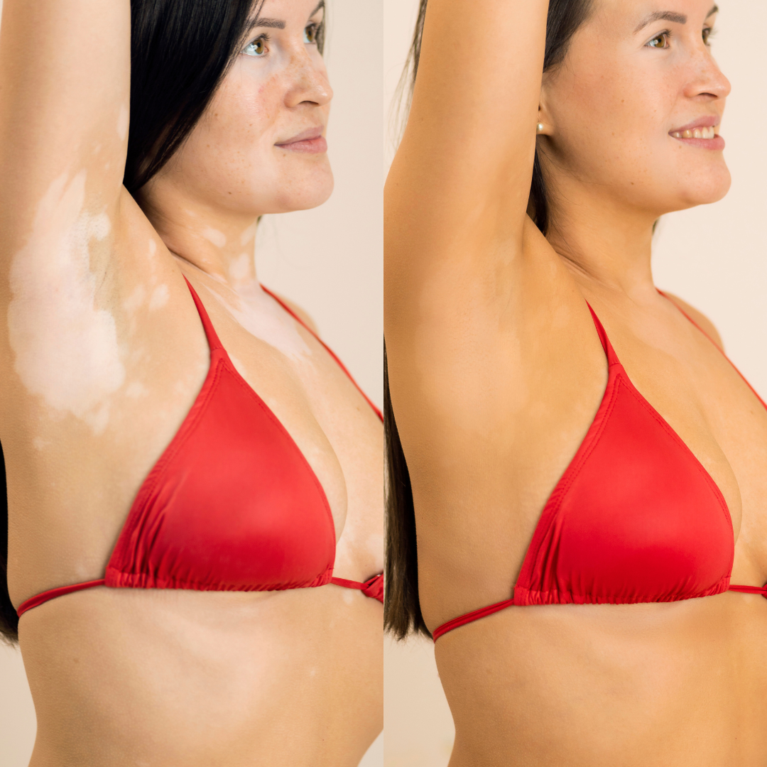 Aplicação em Vitiligo — Solução Plus — bronzeamento saudável Vitiligo Solução Plus