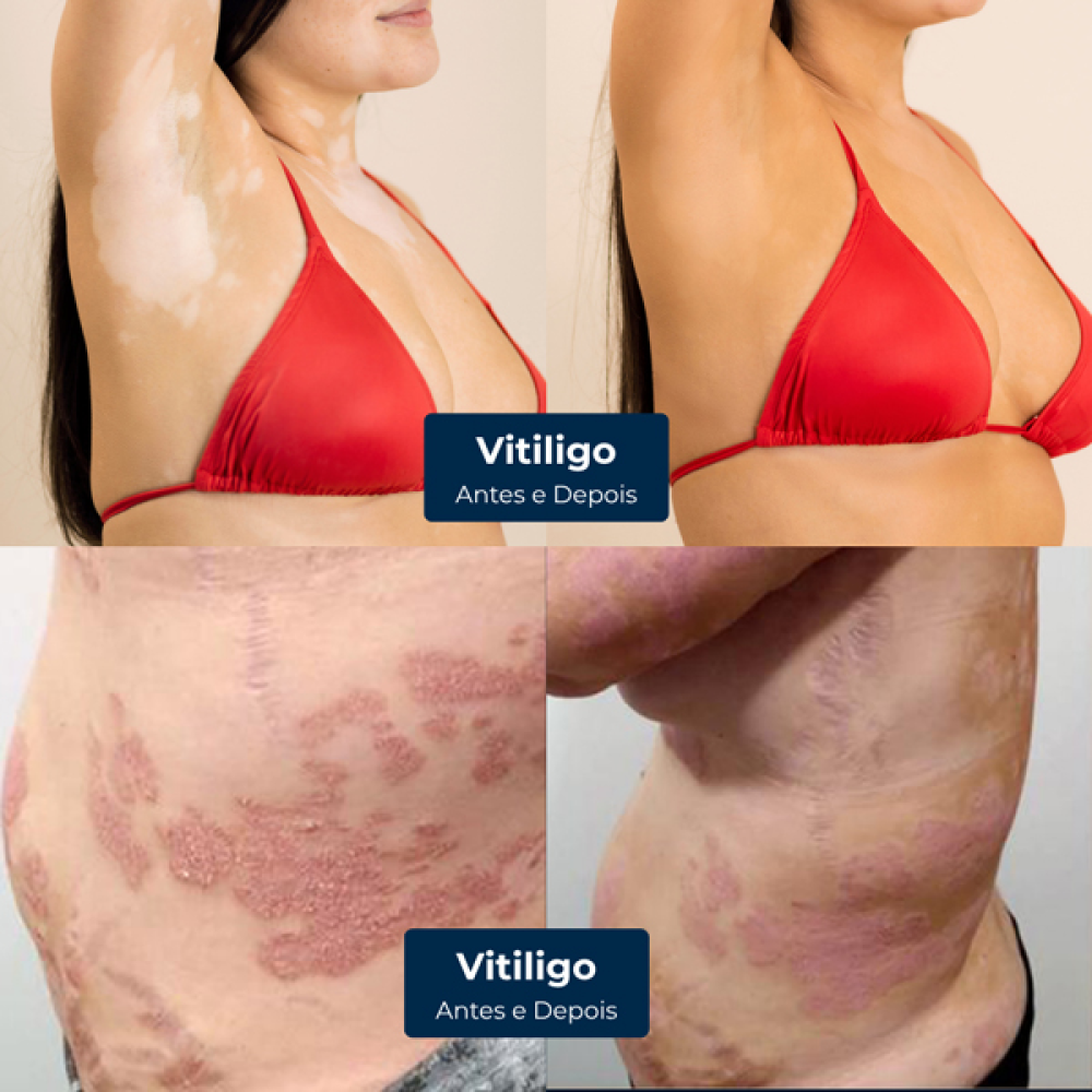 Bronzeamento que trata psoríase e uniformiza vitiligo